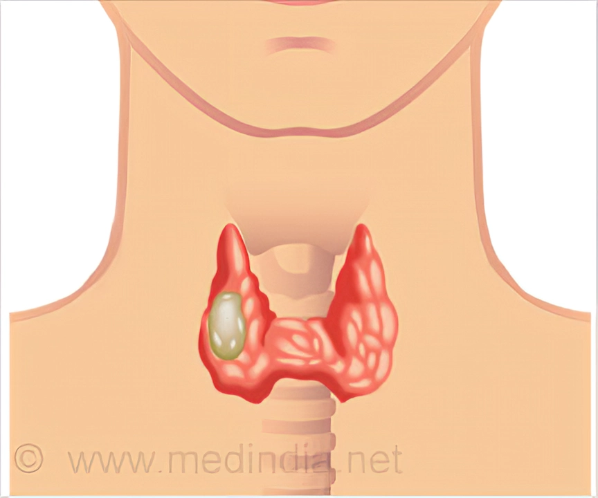Thyroid Cancer: Understanding the Causes, Symptoms, and Treatment Options