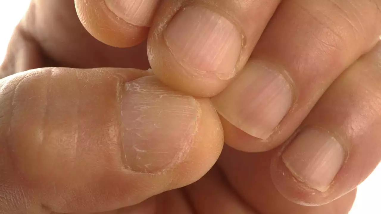 The hidden signs of vitamin deficiency in your nails, skin, and hair