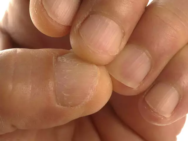 The hidden signs of vitamin deficiency in your nails, skin, and hair